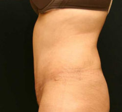 Tummy Tuck