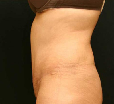 Tummy Tuck