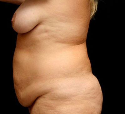 Tummy Tuck