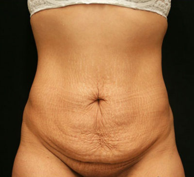Tummy Tuck