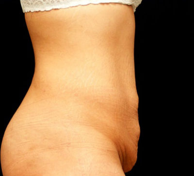 Tummy Tuck