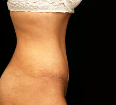 Tummy Tuck