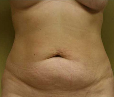 Tummy Tuck