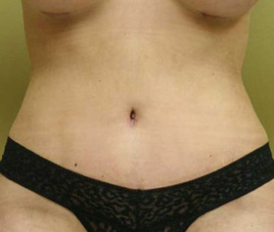 Tummy Tuck