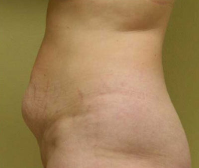 Tummy Tuck