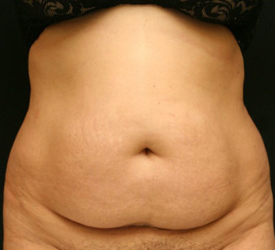 Tummy Tuck