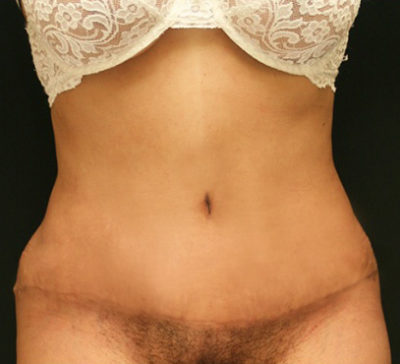 Tummy Tuck