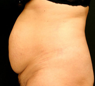 Tummy Tuck