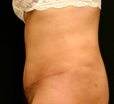 Tummy Tuck