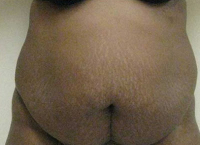 Tummy Tuck