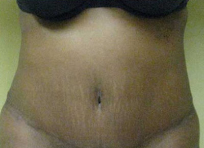 Tummy Tuck