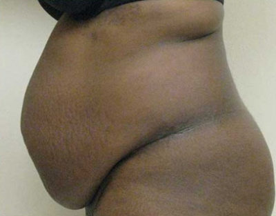 Tummy Tuck