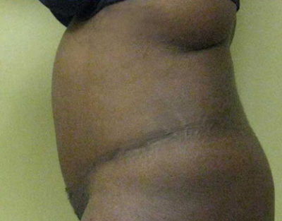 Tummy Tuck