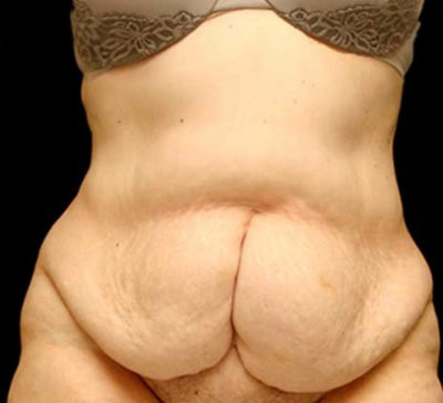 Tummy Tuck