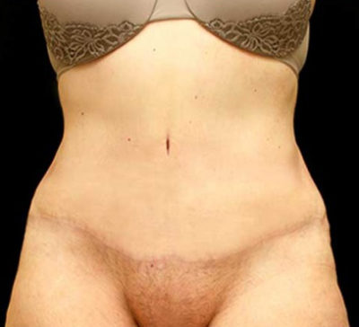 Tummy Tuck