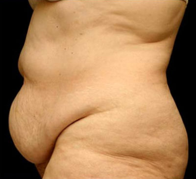 Tummy Tuck