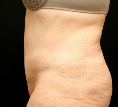 Tummy Tuck