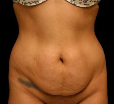 Tummy Tuck