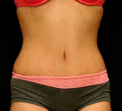 Tummy Tuck