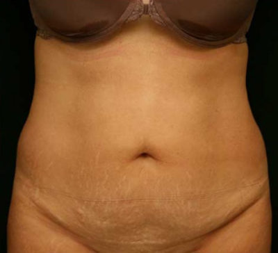 Tummy Tuck