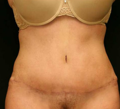 Tummy Tuck