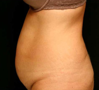 Tummy Tuck