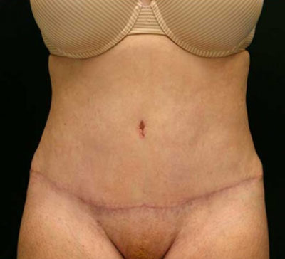 Tummy Tuck