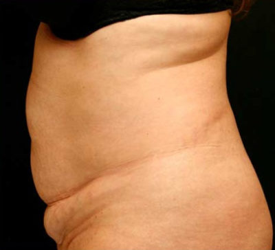 Tummy Tuck