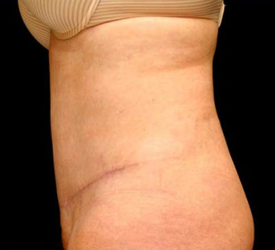 Tummy Tuck