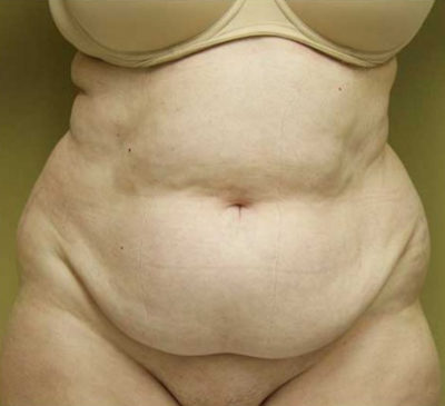 Tummy Tuck