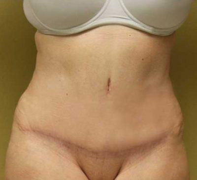 Tummy Tuck