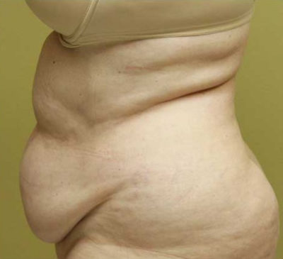 Tummy Tuck