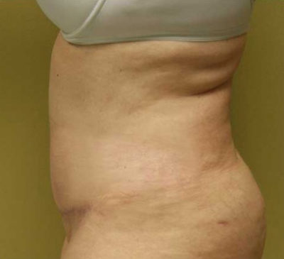 Tummy Tuck