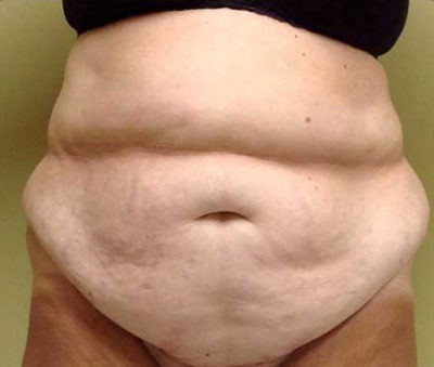 Tummy Tuck