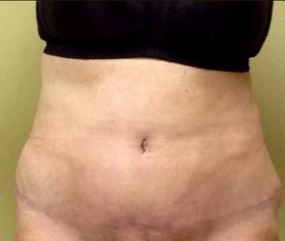Tummy Tuck