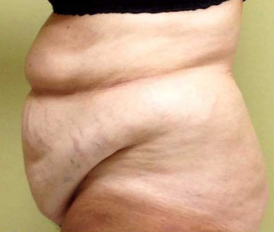 Tummy Tuck