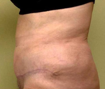 Tummy Tuck