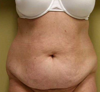 Tummy Tuck