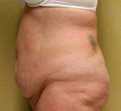 Tummy Tuck