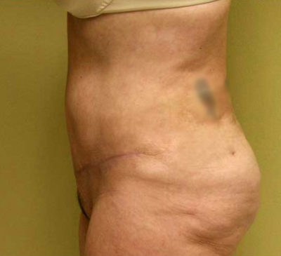 Tummy Tuck
