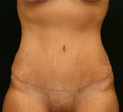 Tummy Tuck