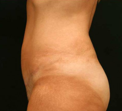 Tummy Tuck