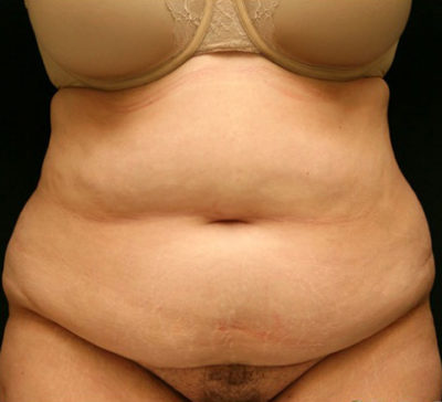 Tummy Tuck