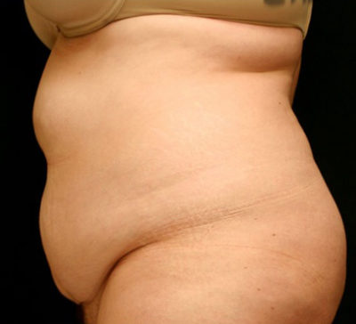 Tummy Tuck