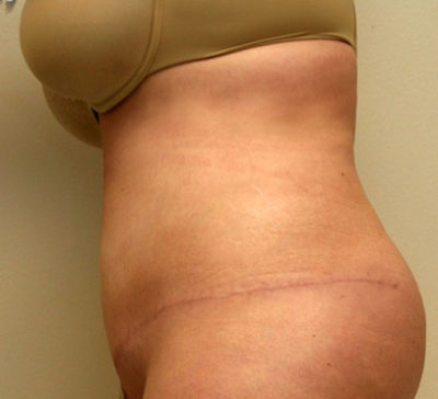 Tummy Tuck