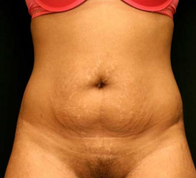 Tummy Tuck
