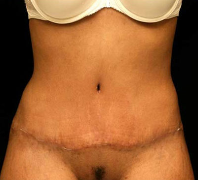 Tummy Tuck