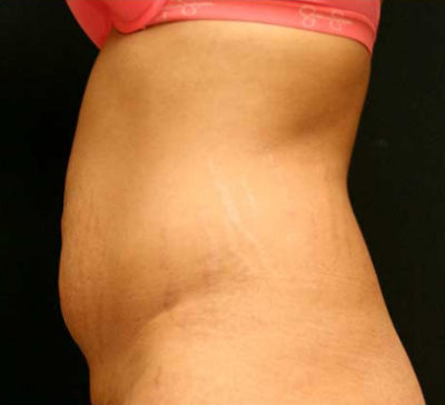 Tummy Tuck