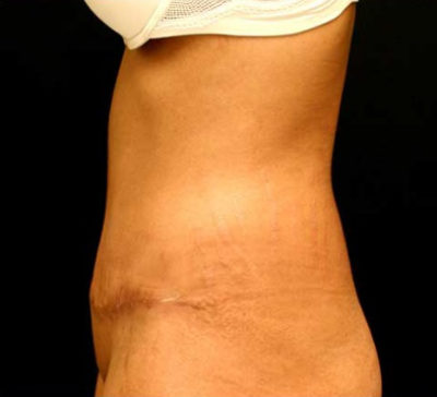 Tummy Tuck