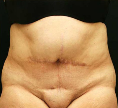 Tummy Tuck